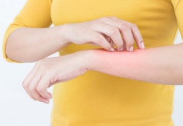 Punture di insetti: un aiuto dall'omeopatia 