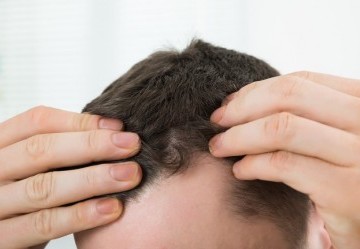 Caduta dei capelli: ecco tutti i rimedi
