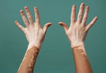 Vitiligine: cause, conseguenze e cure disponibili