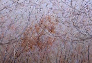 Come difendere la pelle dalla cheratosi attinica