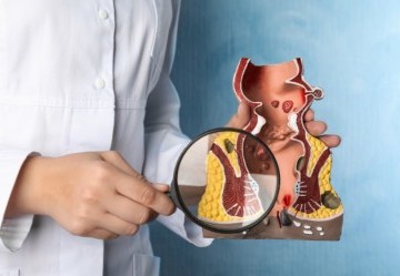 Emorroidi: cosa sono, cause e sintomi