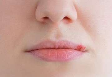 Come combattere l'herpes labiale