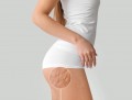Come eliminare la cellulite senza farmaci